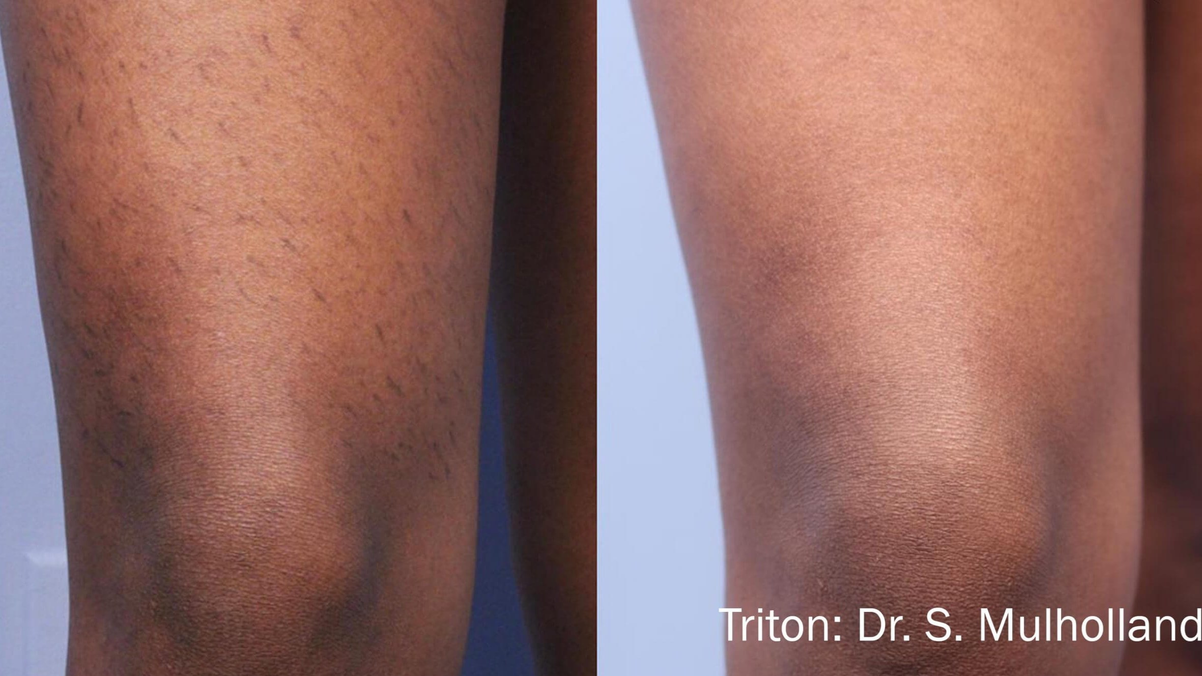 Upper Leg Before and After